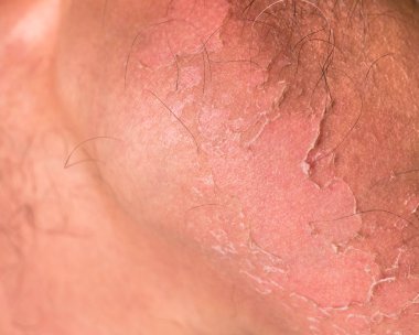 Güneş yanığı peeling küçük detay