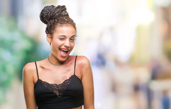 Joven Cabello Trenzado Africano Americano Con Manchas Pigmentación Marca Nacimiento —  Fotos de Stock