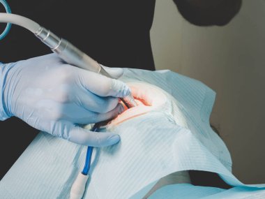 Doktor Diş freze cnc tezgahı ile çalışma. Spesialist özel araçları ile seramik kaplama için hasta diş hazırlayın. Estetik Diş Hekimliği, ilaç, stomatology kavramı.