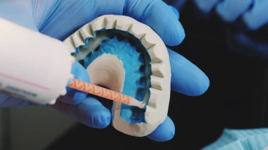 Gelecekteki kaplama için plastik geçici plaka kurulması. Diş hekimi diş tutkal ile 3d çene yağlar. Estetik Diş Hekimliği, ilaç, stomatology kavramı. Görünümü kapatın