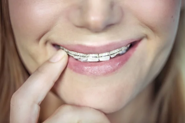 Teenager with braces — Stock Photo, Image