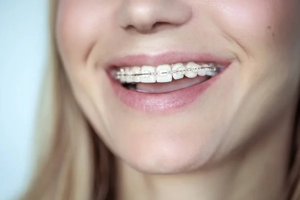 Zahnspange, Behandlung für schiefe Zähne — Stockfoto