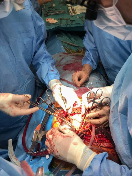 Team di chirurghi che eseguono trapianto d'organo chirurgia medica . — Foto Stock