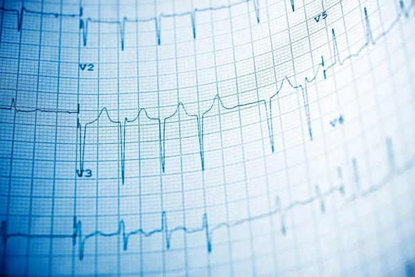 Close up of an electrocardiogram in paper form.