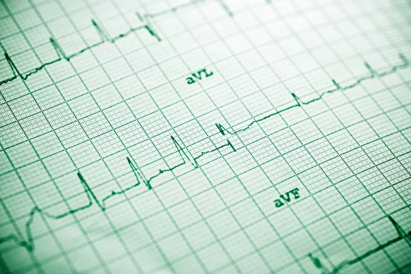 Électrocardiogramme en gros plan — Photo