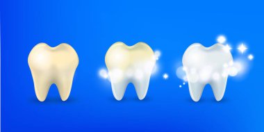 Diş seti. Diş beyazlatma süreci, Sağlıklı Diş, sarı dişler, Koruma Altında, Diş Beyazlatma, parlayan etkisi,3d, gerçekçi, Diş tasarım elemanı, vektör