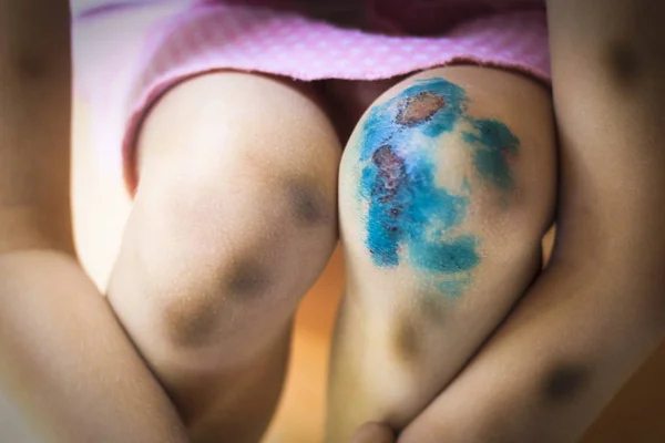Κοριτσάκι Χτύπησε Γόνατό Του Θεραπεία Τραυμάτων Πράσινο Γκρο Πλαν — Φωτογραφία Αρχείου