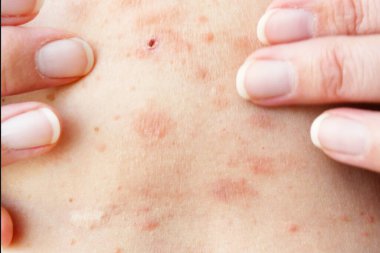 Kadın vücudunda deri döküntüsü tedavisi. Zona, Hastalık, Herpes zoster, varisella-zoster virüsü. Vücudunda kızarıklık ve kabarcıklar var.