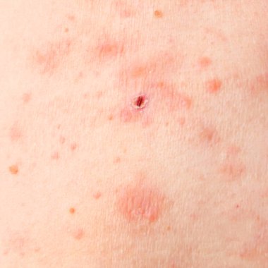 Kadın vücudunda deri döküntüsü tedavisi. Zona, Hastalık, Herpes zoster, varisella-zoster virüsü. Vücudunda kızarıklık ve kabarcıklar var.