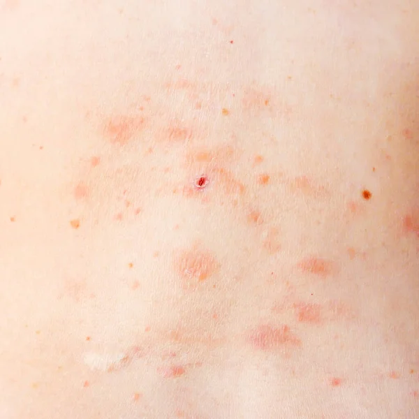 skin rash treatment on woman body. Shingles, Disease, Herpes zoster, varicella-zoster virus. skin rash and blisters on body