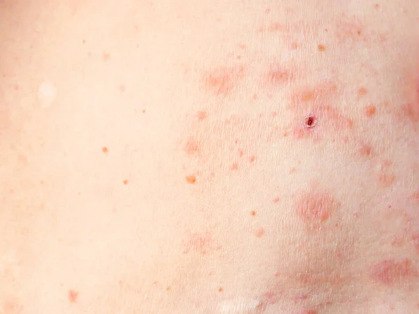 Tratamento Erupção Cutânea Corpo Mulher Telhas Doença Herpes Zoster Vírus — Fotografia de Stock