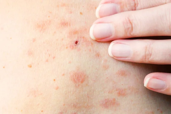 Huiduitslag Behandeling Vrouwelijk Lichaam Gordelroos Ziekte Herpes Zoster Varicella Zoster — Stockfoto