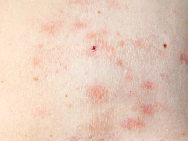 Kožní Vyrážka Léčba Těle Ženy Pásový Opar Choroba Herpes Zoster — Stock fotografie