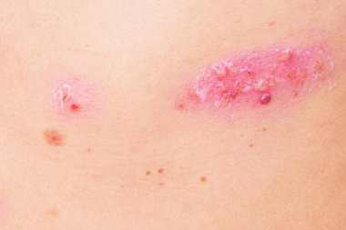 Kadın vücudunda deri döküntüsü tedavisi. Zona, Hastalık, Herpes zoster, varisella-zoster virüsü. Vücudunda kızarıklık ve kabarcıklar var.