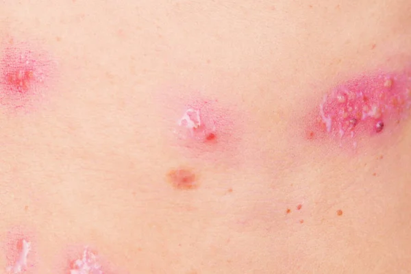 Skin Rash Treatment Woman Body Shingles Disease Herpes Zoster Varicella — Stock Photo, Image