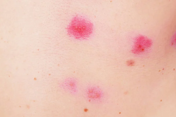 Skin Rash Treatment Woman Body Shingles Disease Herpes Zoster Varicella — Stock Photo, Image