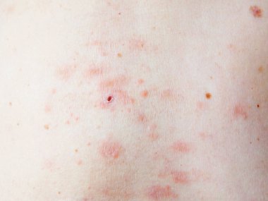 Kadın vücudunda deri döküntüsü tedavisi. Zona, Hastalık, Herpes zoster, varisella-zoster virüsü. Vücudunda kızarıklık ve kabarcıklar var.
