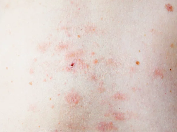 Kadın Vücudunda Deri Döküntüsü Tedavisi Zona Hastalık Herpes Zoster Varisella — Stok fotoğraf