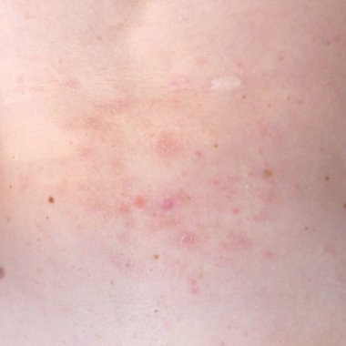 Kadın vücudunda deri döküntüsü tedavisi. Zona, Hastalık, Herpes zoster, varisella-zoster virüsü. Vücudunda kızarıklık ve kabarcıklar var. Arkaplan
