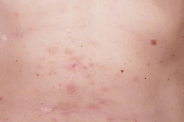 Tratamiento Erupción Cutánea Cuerpo Mujer Herpes Zóster Enfermedad Herpes Zóster — Foto de Stock