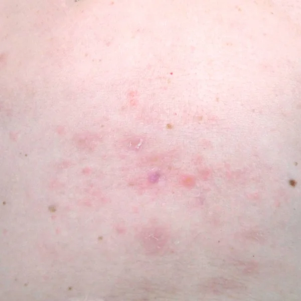 Kožní Vyrážka Léčba Těle Ženy Pásový Opar Choroba Herpes Zoster — Stock fotografie