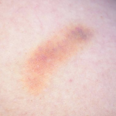 Bacakları morarmış, iş yerinde cinsel taciz, yakın plan.