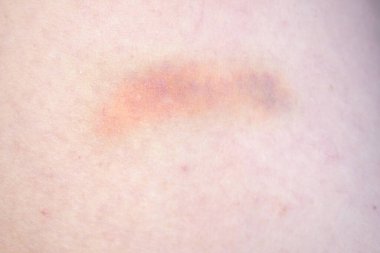 Bacakları morarmış, iş yerinde cinsel taciz, yakın plan.