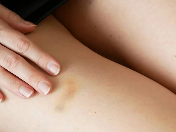 Beautiful Girl Legs Big Bruise Skirt Sexual Harassment Work Concept — Stock Photo, Image