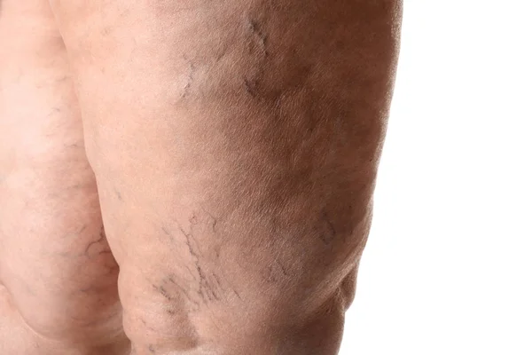 Patas Mujer Con Varices Sobre Fondo Blanco Primer Plano —  Fotos de Stock