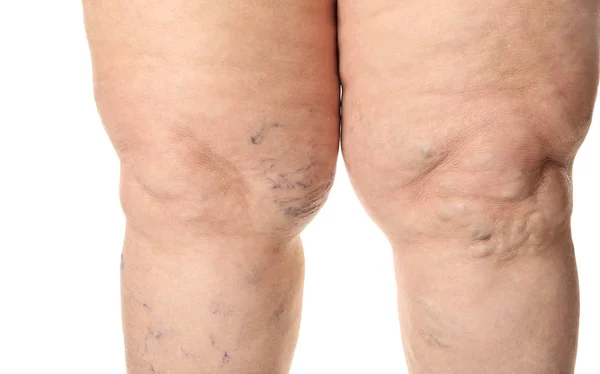 Ženské Nohy Křečovými Bílém Pozadí Closeup — Stock fotografie