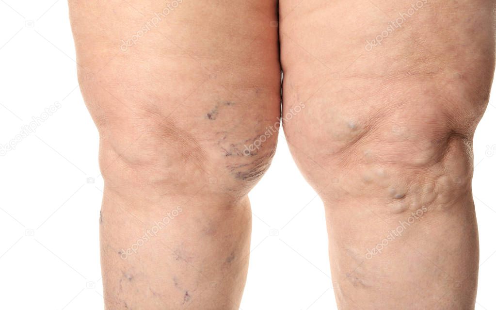 Woman's legs with varicose on white background, closeup