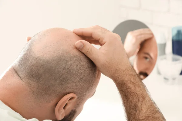 Muž Problémem Vypadávání Vlasů Hledá Zrcadle — Stock fotografie