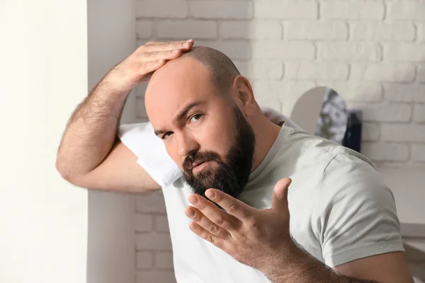 Pria Dengan Masalah Rambut Rontok Rumah — Stok Foto
