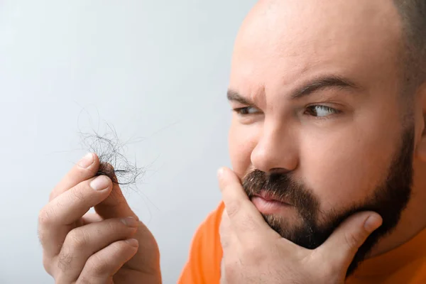 Homem Com Problema Perda Cabelo Fundo Claro — Fotografia de Stock