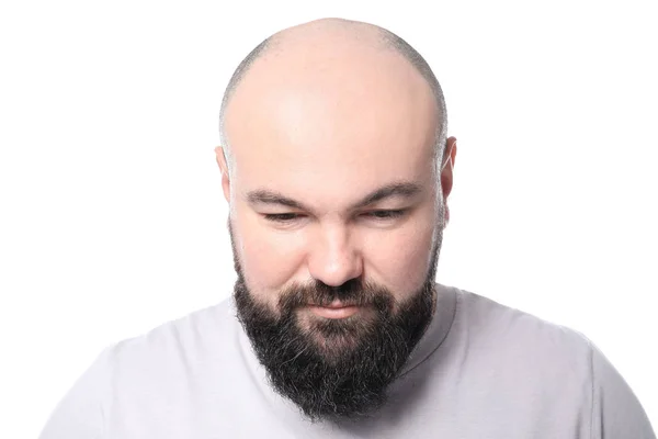 Man Hair Loss Problem White Background — Stock Photo, Image