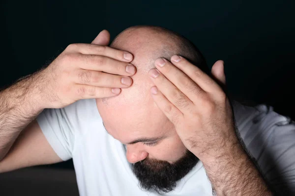 Man Hair Loss Problem Dark Background — Stock Photo, Image