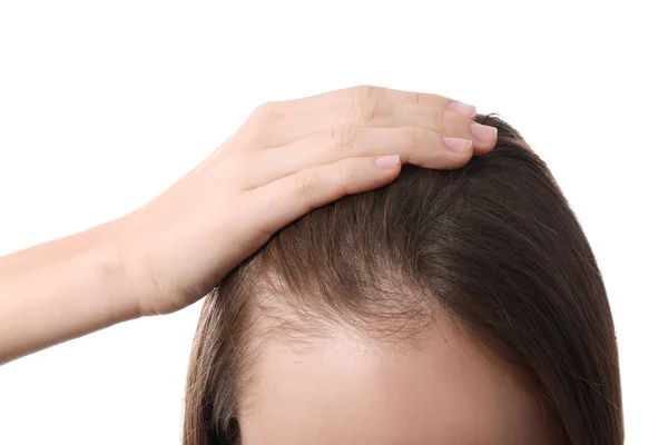Жінка Проблемою Випадіння Волосся Білому Тлі Крупним Планом — стокове фото