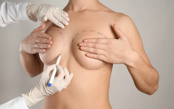 Marcas Desenho Médico Peito Feminino Antes Cirurgia Estética Contra Fundo — Fotografia de Stock