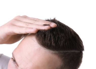 Saç dökülmesi sorunu beyaz arka planda, closeup adamla