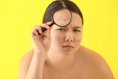 Portrait of young Asian woman with acne problem and magnifier on color background clipart