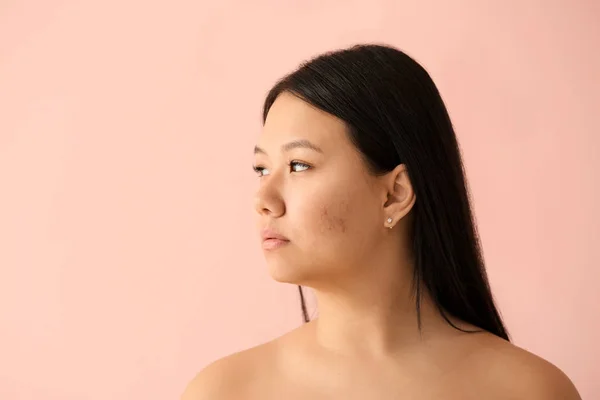 Portrait Young Asian Woman Acne Problem Color Background — Stock Photo, Image
