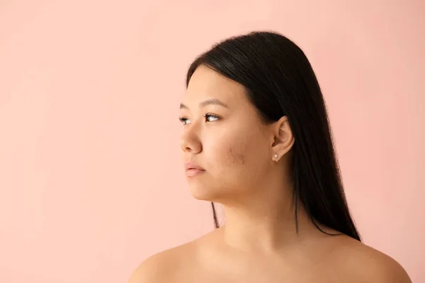 Portrait of young Asian woman with acne problem on color background