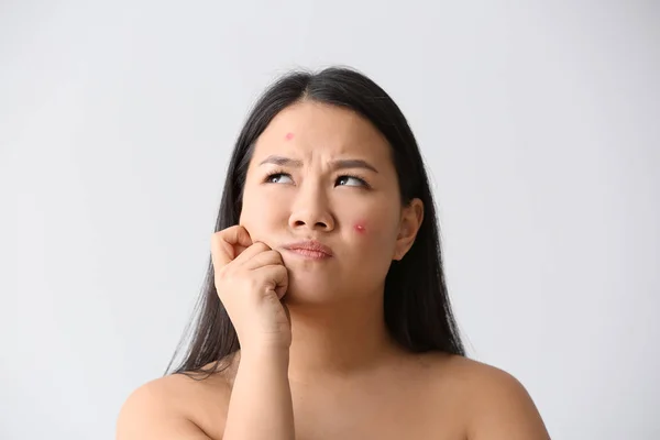 Portrait Young Asian Woman Acne Problem White Background — Stock Photo, Image