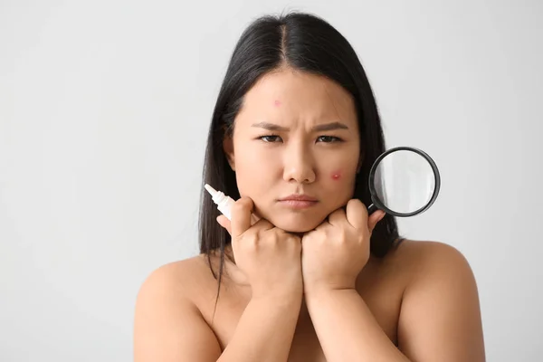 Retrato Mujer Asiática Joven Con Remedio Para Acné Lupa Sobre — Foto de Stock