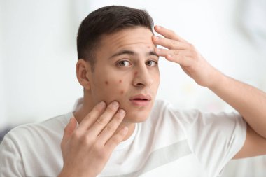 Akne problemi evde olan genç adam portresi