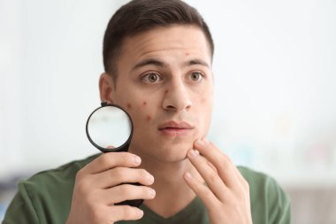 Akne problemi ve evde büyüteç ile genç adam portresi