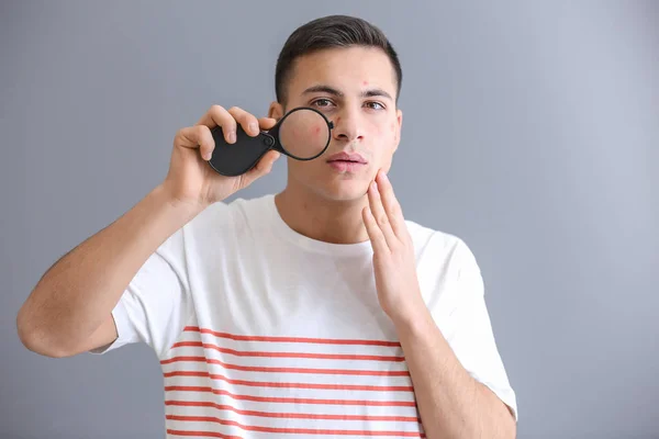 Portrait Young Man Acne Problem Magnifier Grey Background — Stock Photo, Image