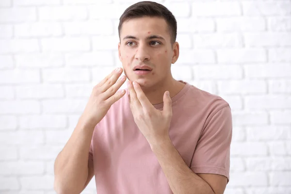 Retrato Hombre Joven Con Acné Problema Contra Pared Ladrillo Blanco — Foto de Stock