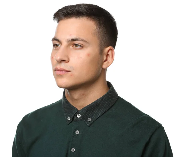 Portret Van Een Jonge Man Met Acneprobleem Witte Achtergrond — Stockfoto