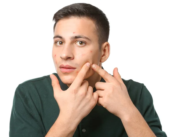 Portrait Young Man Acne Problem Squishing Pimples White Background — Stock Photo, Image